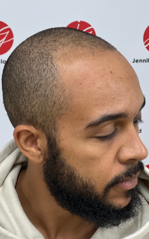 Avant tricopigmentation