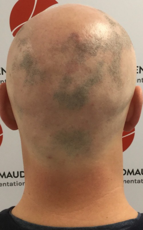 Avant tricopigmentation