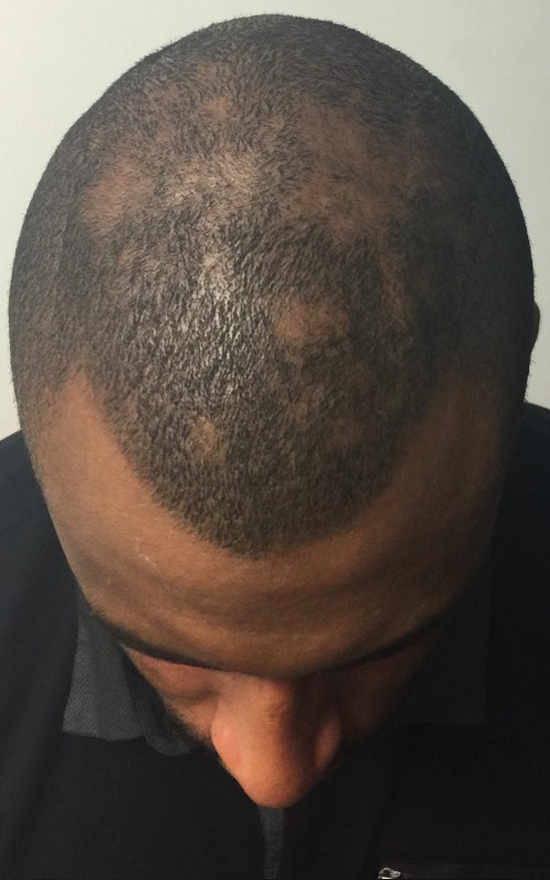 Avant tricopigmentation