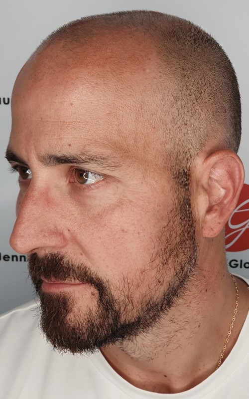 Avant tricopigmentation