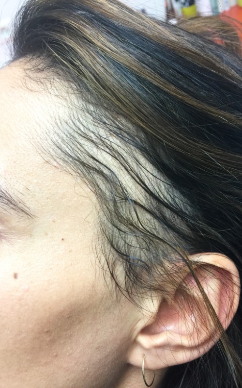 Avant tricopigmentation