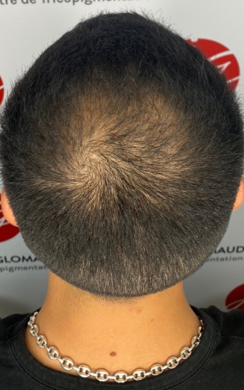 Avant tricopigmentation