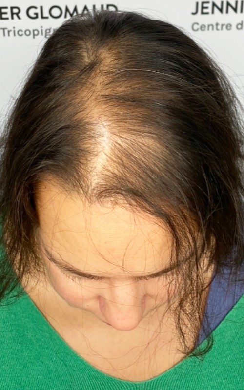 Avant tricopigmentation