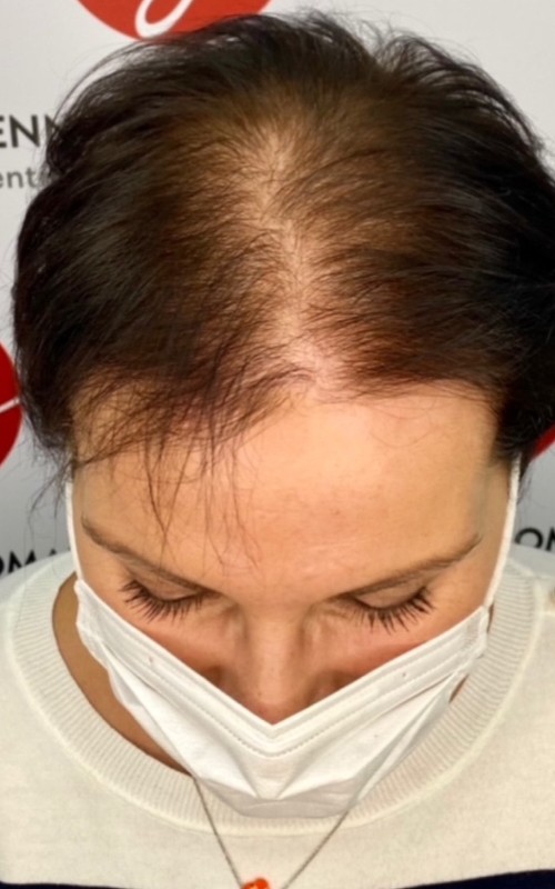 Avant tricopigmentation