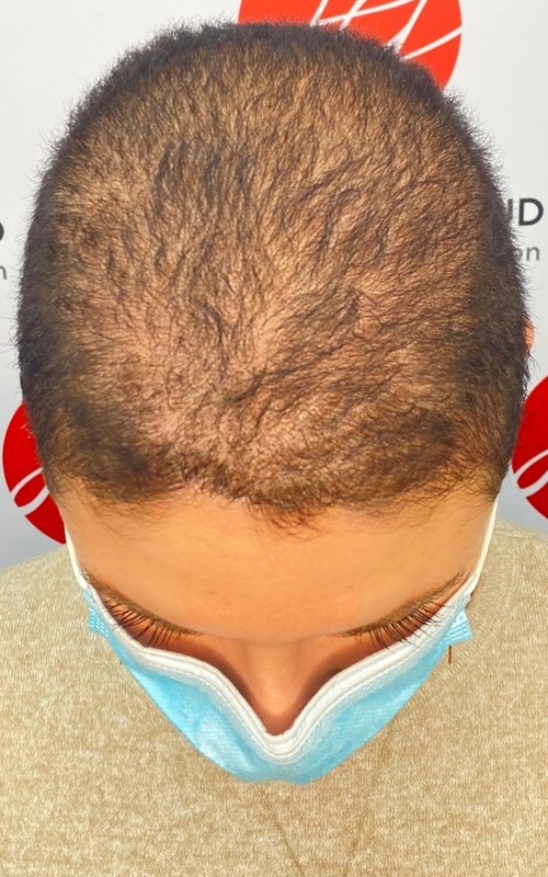 Avant tricopigmentation