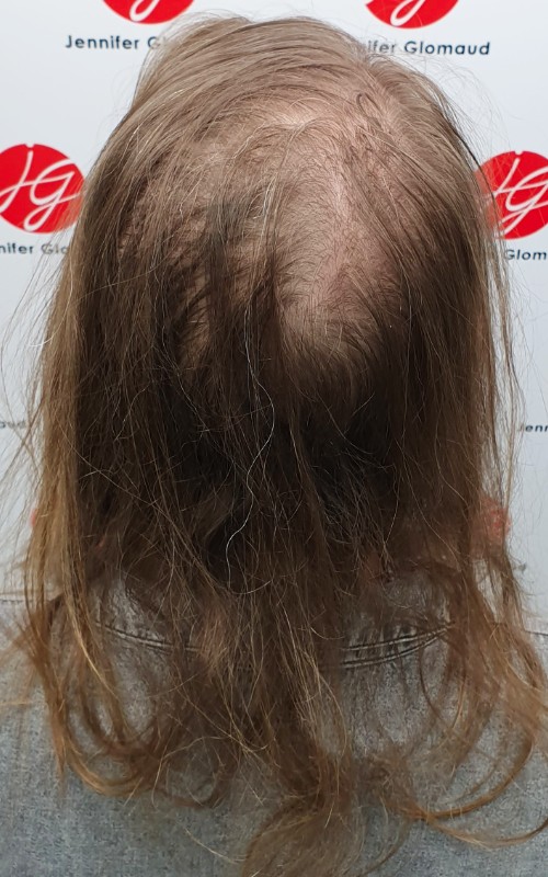 Avant tricopigmentation