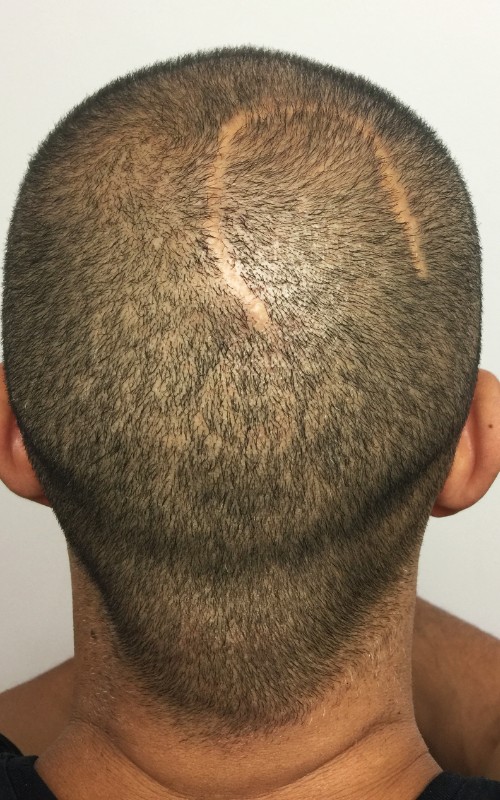 Avant tricopigmentation