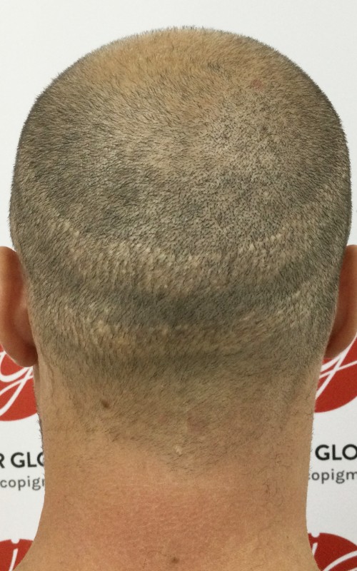 Avant tricopigmentation