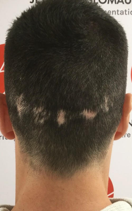 Avant tricopigmentation