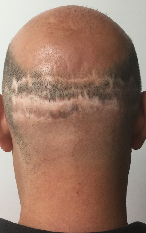 Avant tricopigmentation