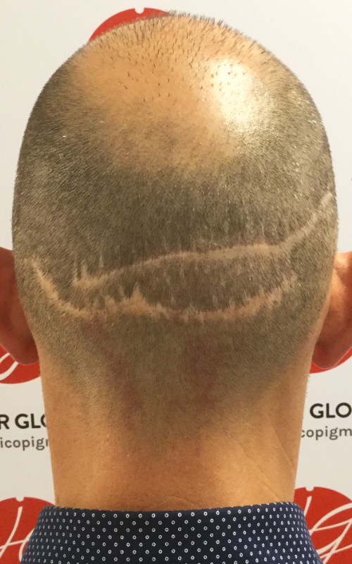 Avant tricopigmentation