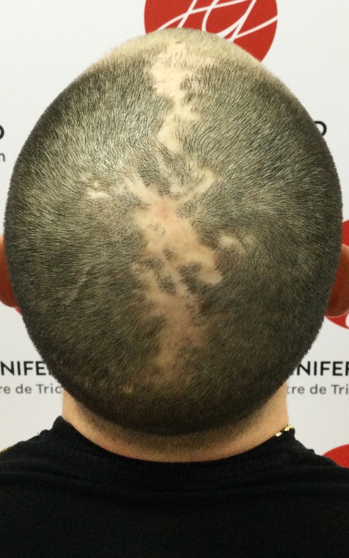 Avant tricopigmentation