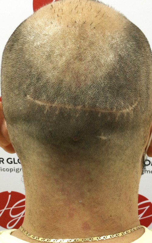 Avant tricopigmentation