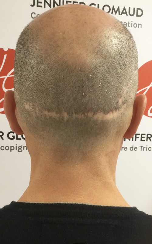 Avant tricopigmentation