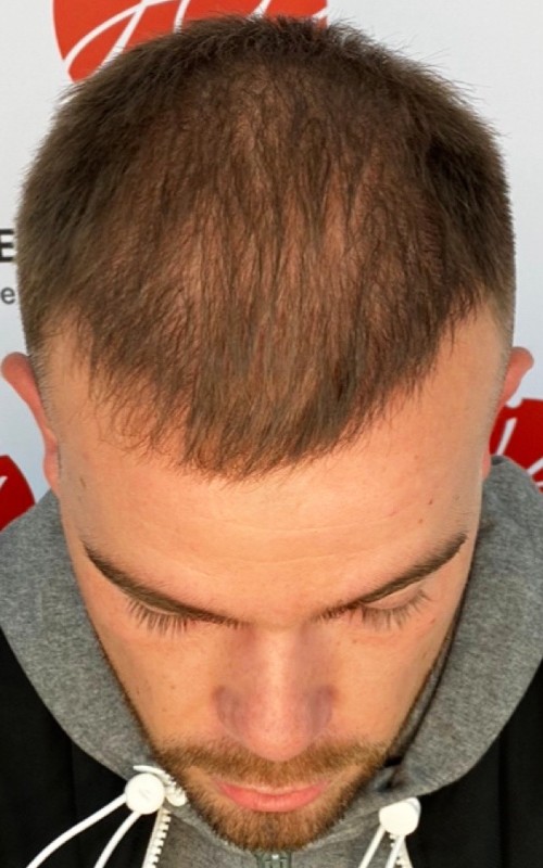 Avant tricopigmentation