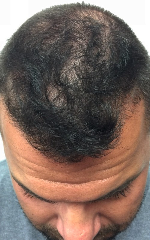 Avant tricopigmentation