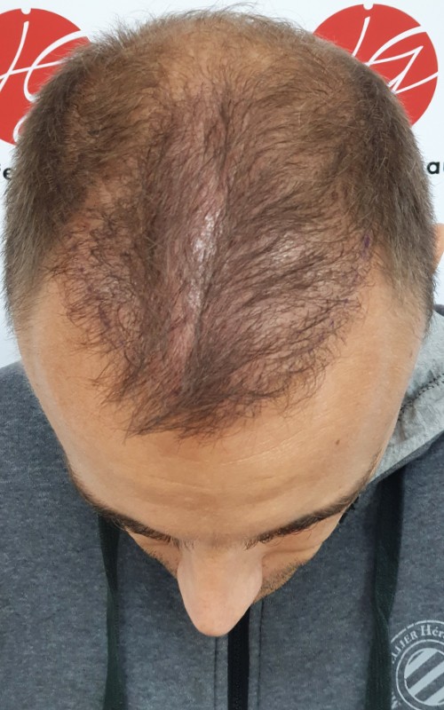 Avant tricopigmentation