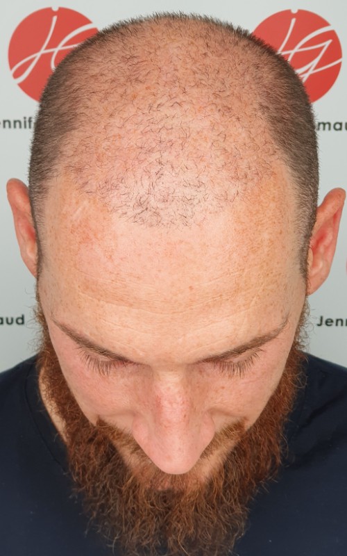 Avant tricopigmentation