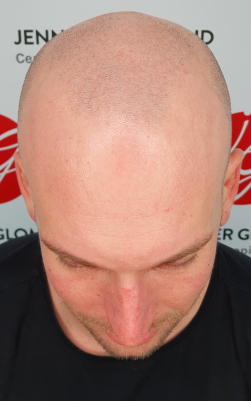 Avant tricopigmentation