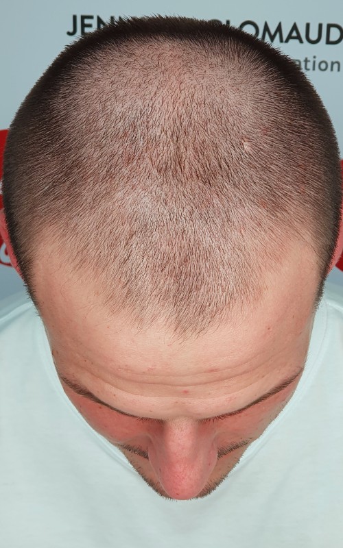 Avant tricopigmentation