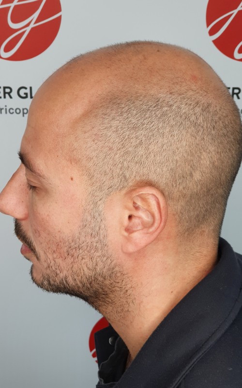 Avant tricopigmentation