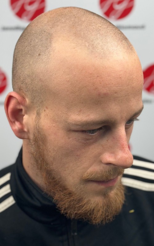 Avant tricopigmentation