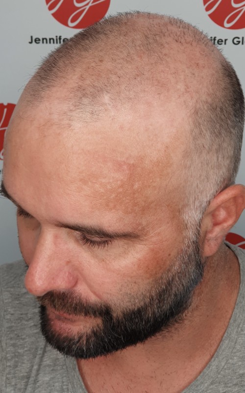 Avant tricopigmentation