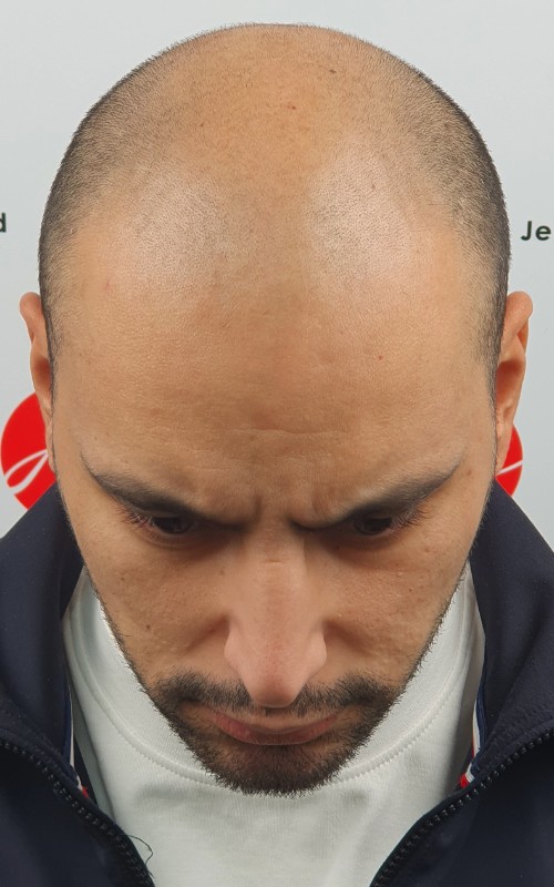 Avant tricopigmentation