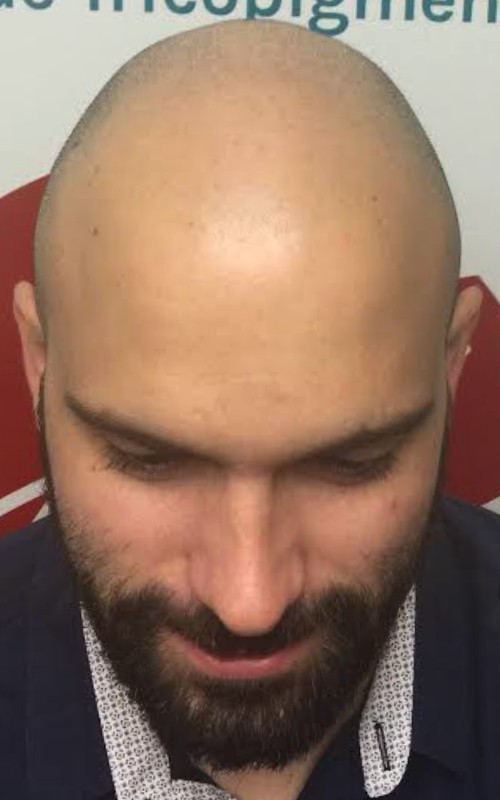 Avant tricopigmentation