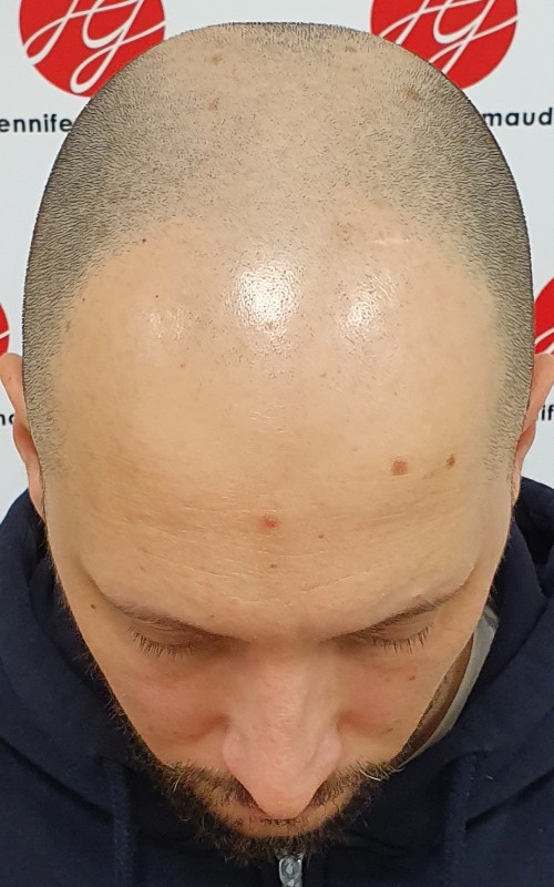 Avant tricopigmentation