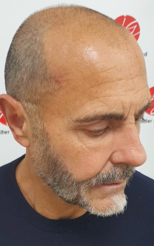 Avant tricopigmentation