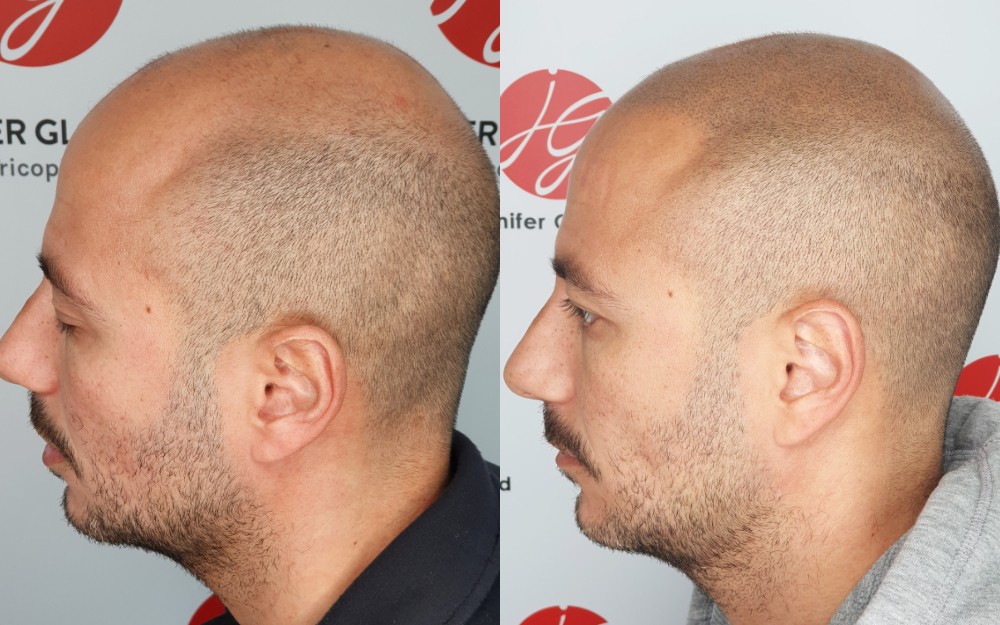 Avant / aprés d'un tatouage capillaire pour homme effet crâne rasé