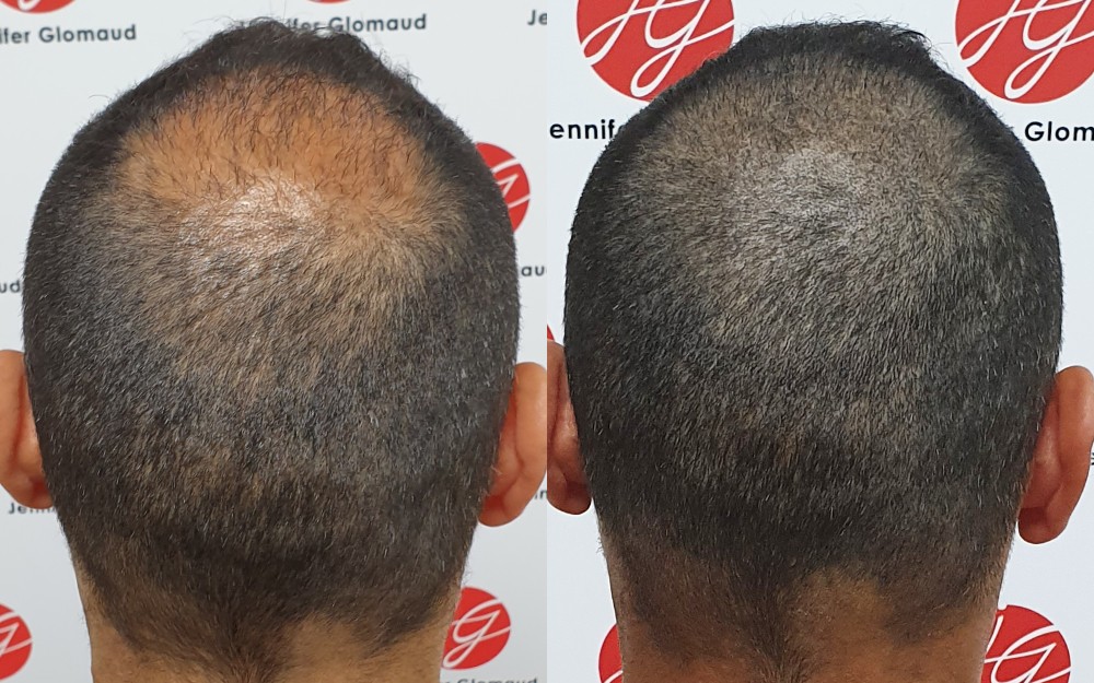 Avant / aprés d'un tatouage capillaire pour homme effet de densité sur cheveux courts