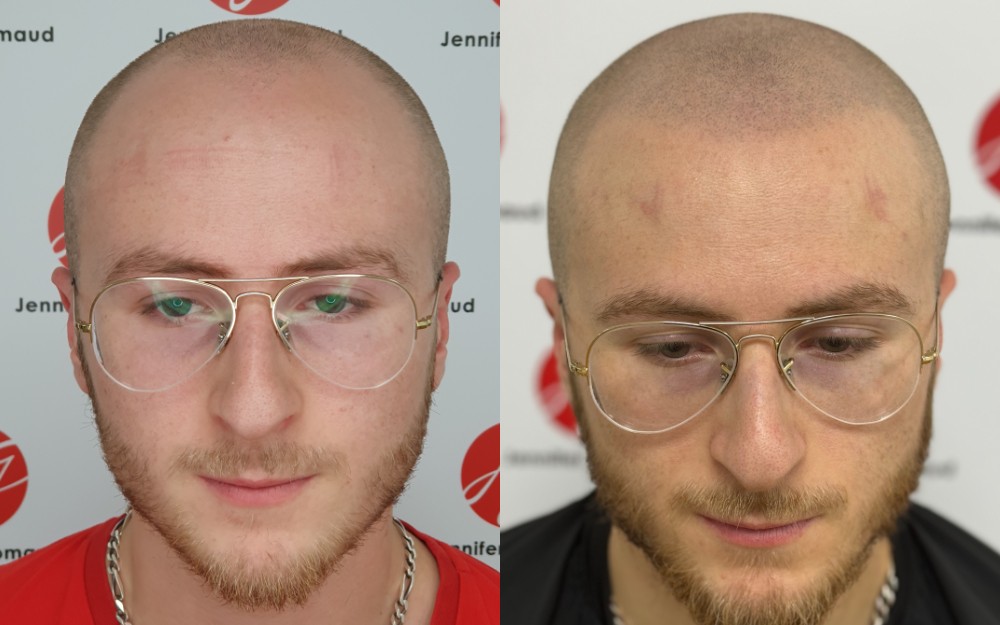 Avant / aprés d'un tatouage de cheveux sur homme effet crâne rasé