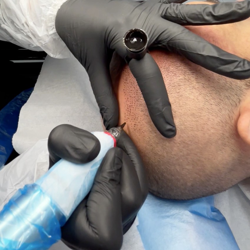 Tricopigmentation