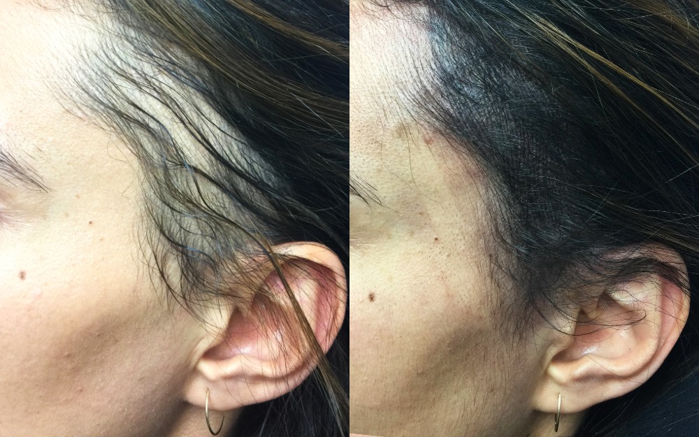 Avant après d'une tricopigmentation effet densité de cheveux sur une femme - Centre Jennifer Glomaud