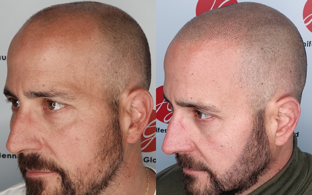 Avant / Après d'une tricopigmentation pour homme densification d'une barbe - Centre Jennifer Glomaud