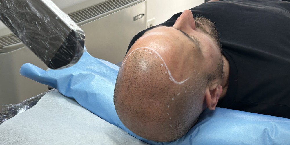 Tricopigmentation : avantages et inconvénients