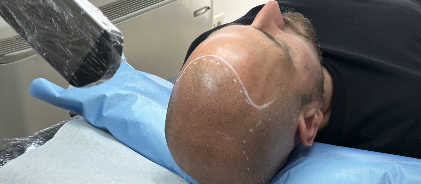 Tricopigmentation : avantages et inconvénients