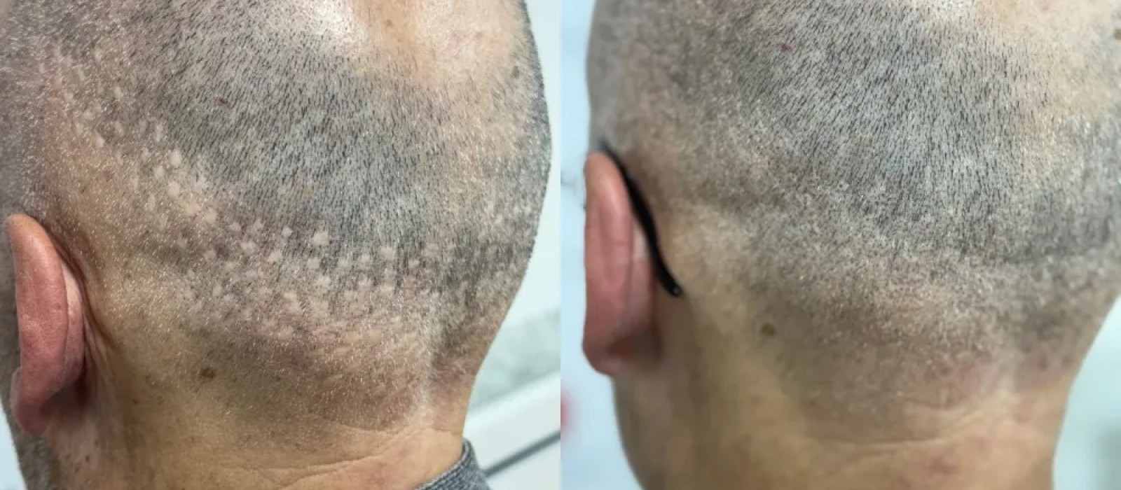 Compléter votre greffe capillaire avec la tricopigmentation