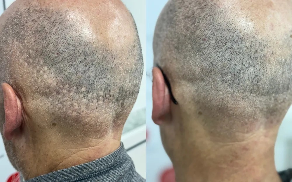 Camouflage de cicatrices visibles après une greffe de cheveux avec la tricopigmentation