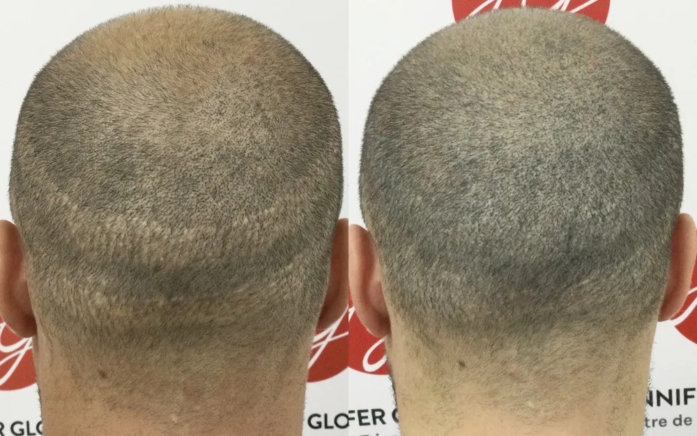 Camouflage de cicatrices et densification de la chevelure après une greffe de cheveux avec la tricopigmentation