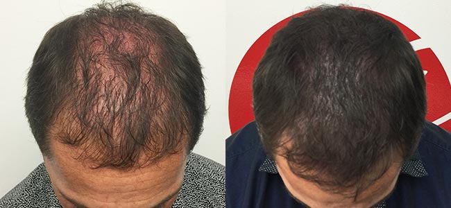 Témoignage d'une tricopigmentation homme pour un effet densité sur cheveux mi-court - Patrick R. - Centre Jennifer Glomaud