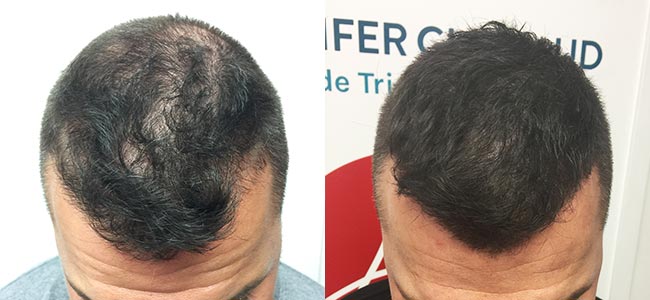 Témoignage d'une tricopigmentation homme pour un effet densité sur cheveux courts - Stéphane L. - Centre Jennifer Glomaud