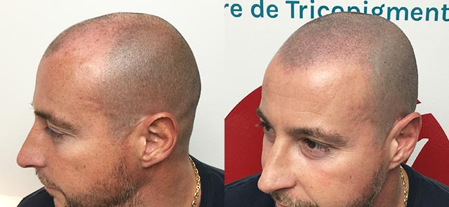 Témoignage d'une tricopigmentation homme pour un effet rasé - Thierry C. - Centre Jennifer Glomaud