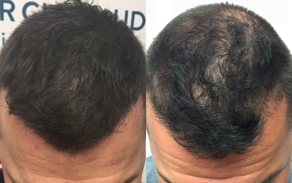 Avant / aprés d'un tatouage capillaire pour homme effet de densité sur cheveux courts