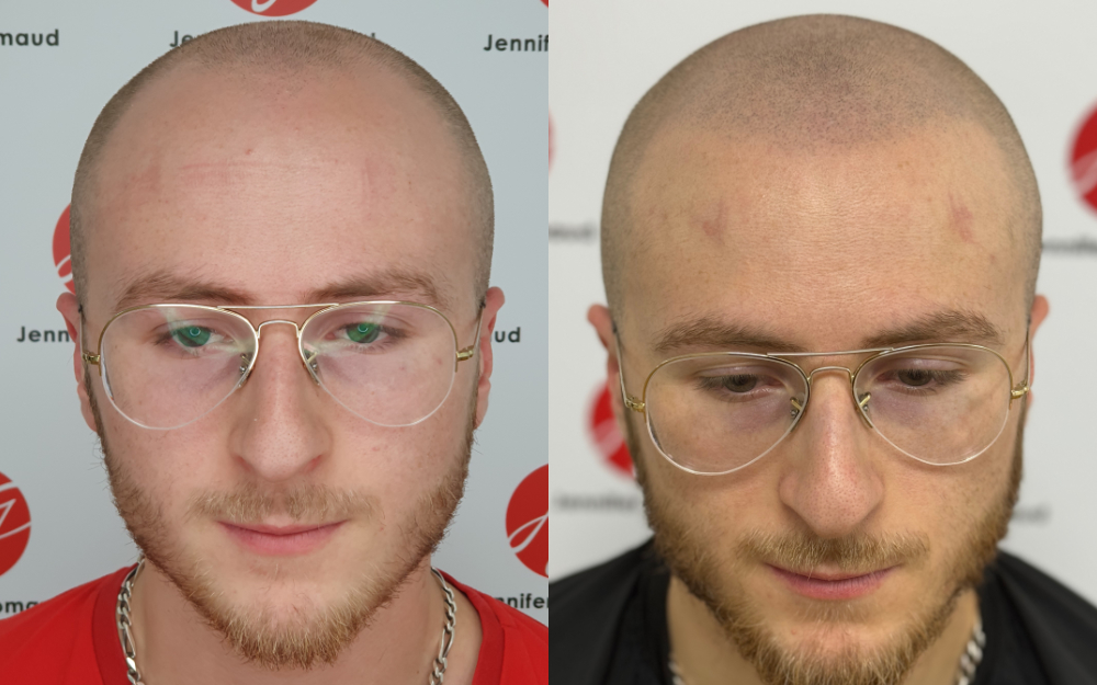 Avant / aprés d'un tatouage de cheveux sur homme effet crâne rasé
