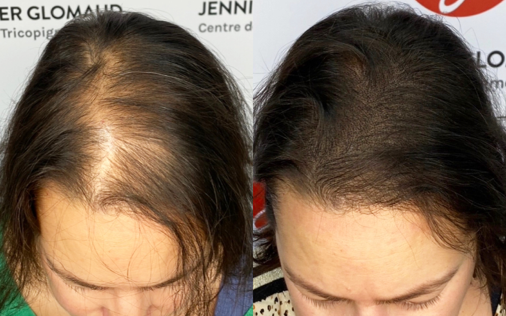 Dermopigmentation capillaire effet densité sur une femme