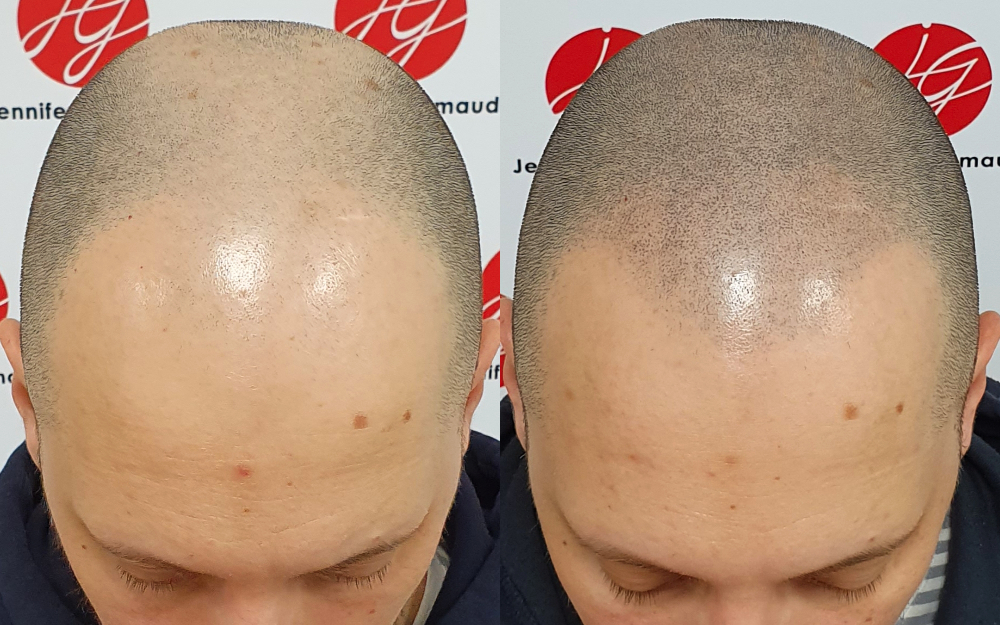 Dermopigmentation capillaire effet crâne rasé sur un homme