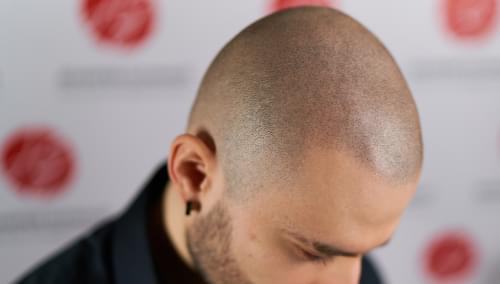 Exemple de tricopigmentation - Centre Jennifer Glomaud